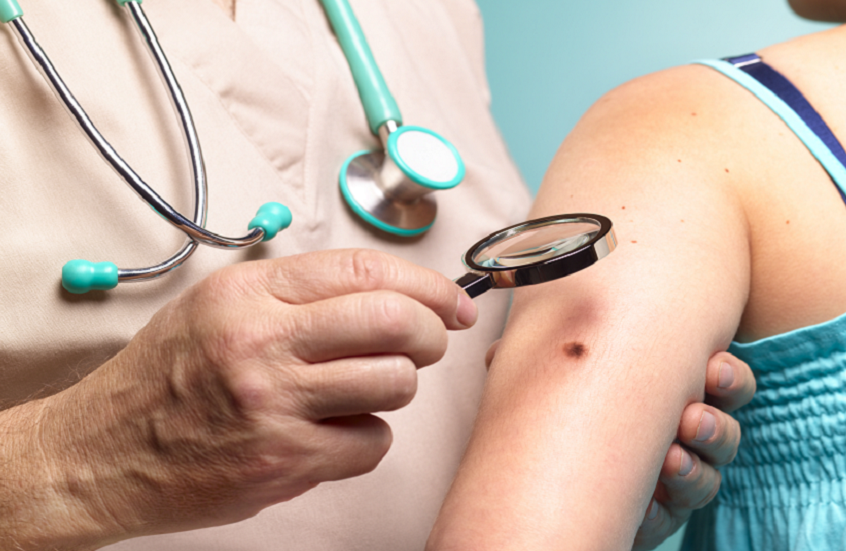 متى تكون الشامة مقلقة؟ مؤشرات تستوجب الفحص الطبي الفوري