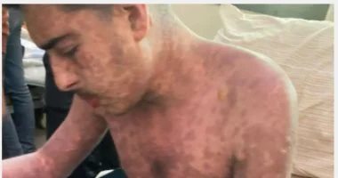 بعد أيام من نشر قصته وفاة الشاب الفلسطيني محمد ضبان بمتلازمة ستيفن جونسون