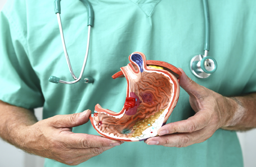 أخصائي أورام يوضح طبيعة سرطان المعدة وأسبابه وأعراضه