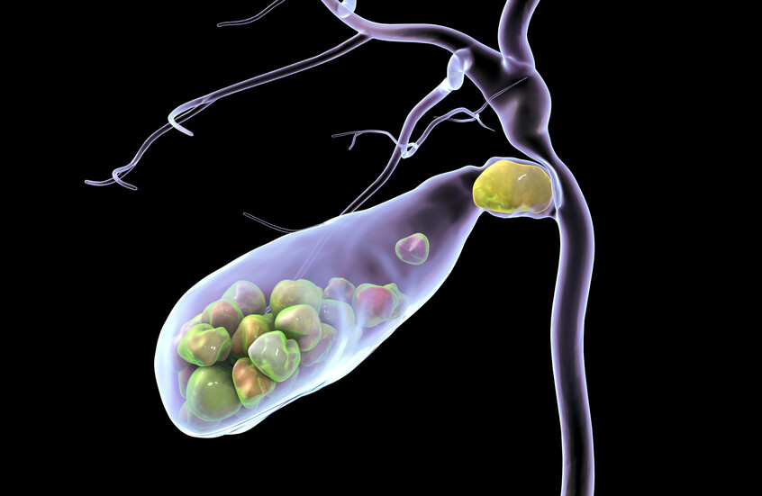 دراسة: الإفراط في السكر يرتبط بزيادة خطر حصوات المرارة